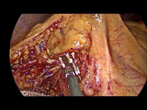 Laparoscopic Rt Hemicolectomy with D2 lymphadenectomy [Video]