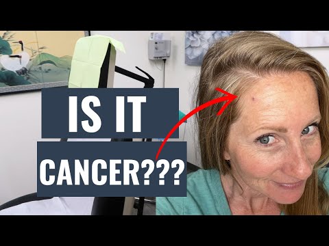 Is it CANCER? | My recent skin cancer journey. [Video]