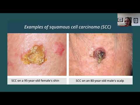 CELL Series: Skin Cancer Prevention & Early Detection [Video]