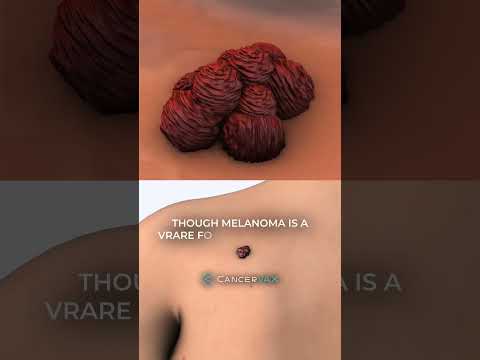 Popular streamer Ninja diagnosed with Melanoma [Video]