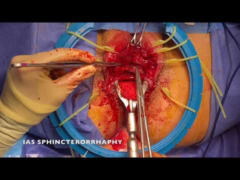 Urgent repair of the anal sphincter complex after type IV obstetric tear [Video]