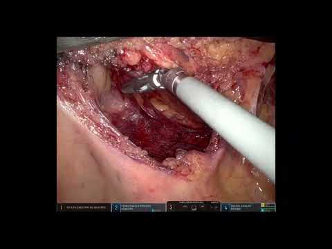 Robotic Ileocolic Resection for Crohn’s Disease with Iliopsoas Fistula [Video]