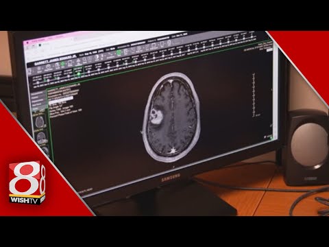 Health Spotlight | Immunotherapy targets brain cancer [Video]