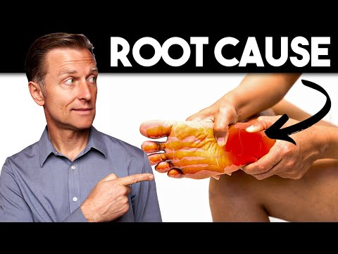 Peripheral NEUROPATHY (Root Cause and Best Remedy) — Dr. Berg [Video]