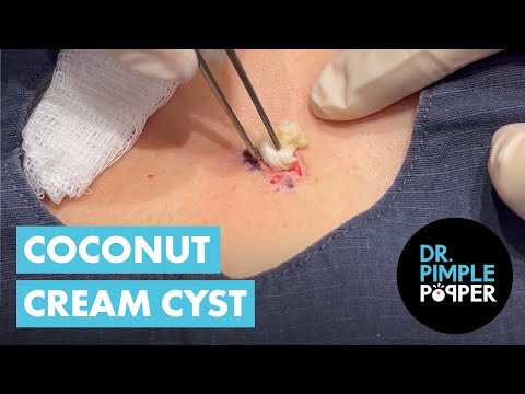 A Coconut Cream Cyst on the Chest 🥥🥥 [Video]