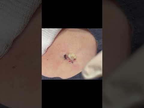 A Coconutcream Cyst on the Chest 🥥🥥 [Video]