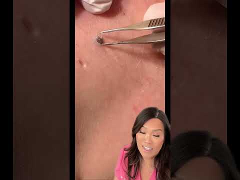 Some great blackheads and DPOWs on the back [Video]