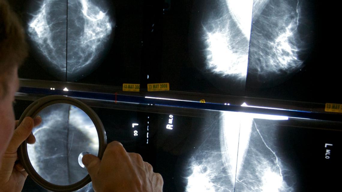 What age should I get a mammogram? Experts now say age 40 [Video]
