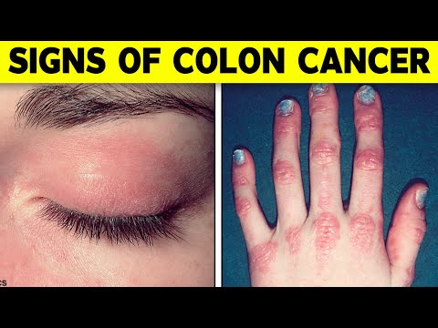 Weird Signs Of Colon Cancer Found On The Skin [Video]