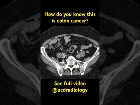 Colon cancer on CT [Video]
