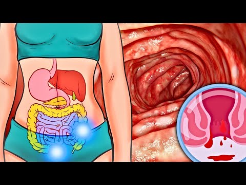 Warning: Early Signals of Colon Cancer. [Video]
