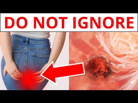 9 Early WARNING Signs Of Colon Cancer You Should NOT Ignore [Video]