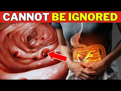 BOWEL IS DYING! Colon Cancer Warning Signs You Shouldn’t ignore! [Video]