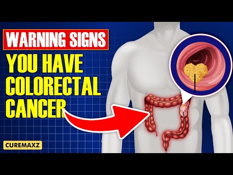 15 Warning signs of Colorectal Cancer [Video]