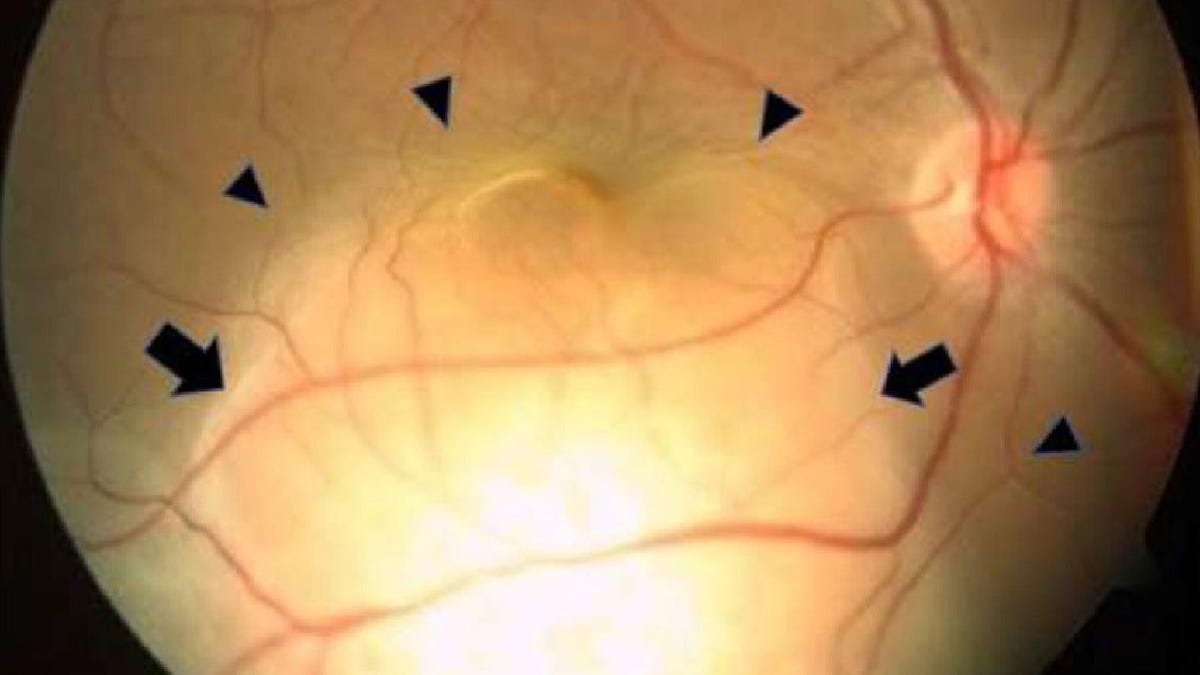 Woman’s Sudden Blindness in One Eye Turned Out to Be Lung Cancer [Video]