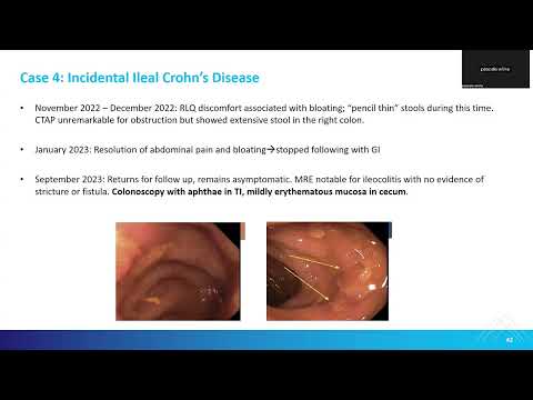 Session 2 Case 4_Incidental Illeal Crohn’s [Video]