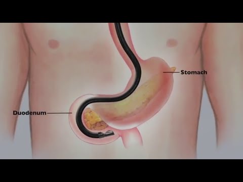 HealthWatch: Early Pancreatic Cancer Detection Gives Patients an Advantage [Video]
