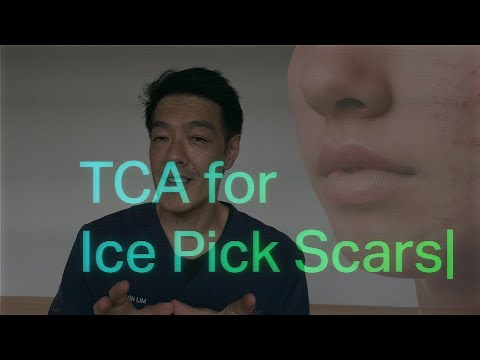 Treatments for Ice pick acne scars | Dr Davin Lim [Video]