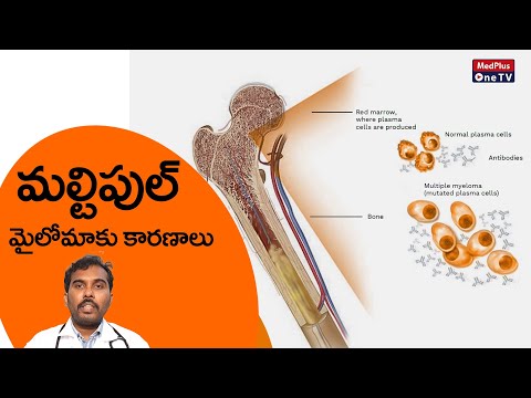 Multiple Myeloma Causes, Symptoms and Treatment | Dr.Rajesh Bollam @MedPlusONETV [Video]