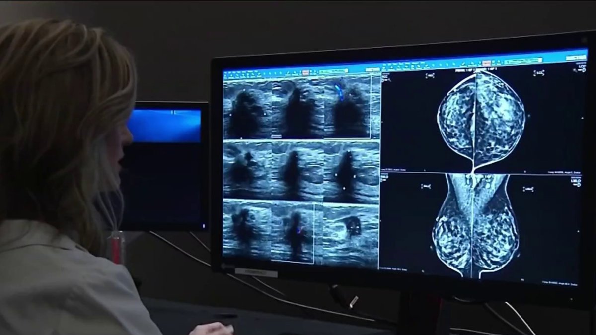 New guidelines for breast cancer screenings  NBC Boston [Video]