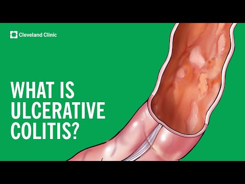 What Is Ulcerative Colitis? [Video]