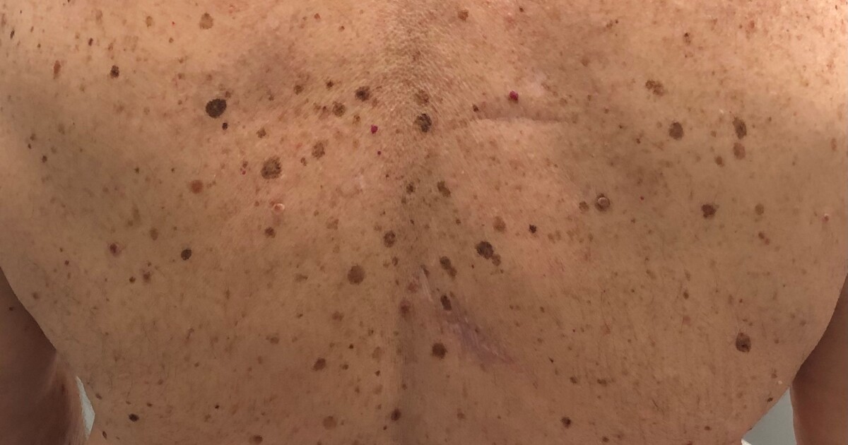 The ABCDE’s of Melanoma [Video]