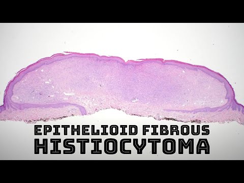 Epithelioid fibrous histiocytoma (EFH) an ALK-1 positive spindle cell tumor (pathology dermatology) [Video]