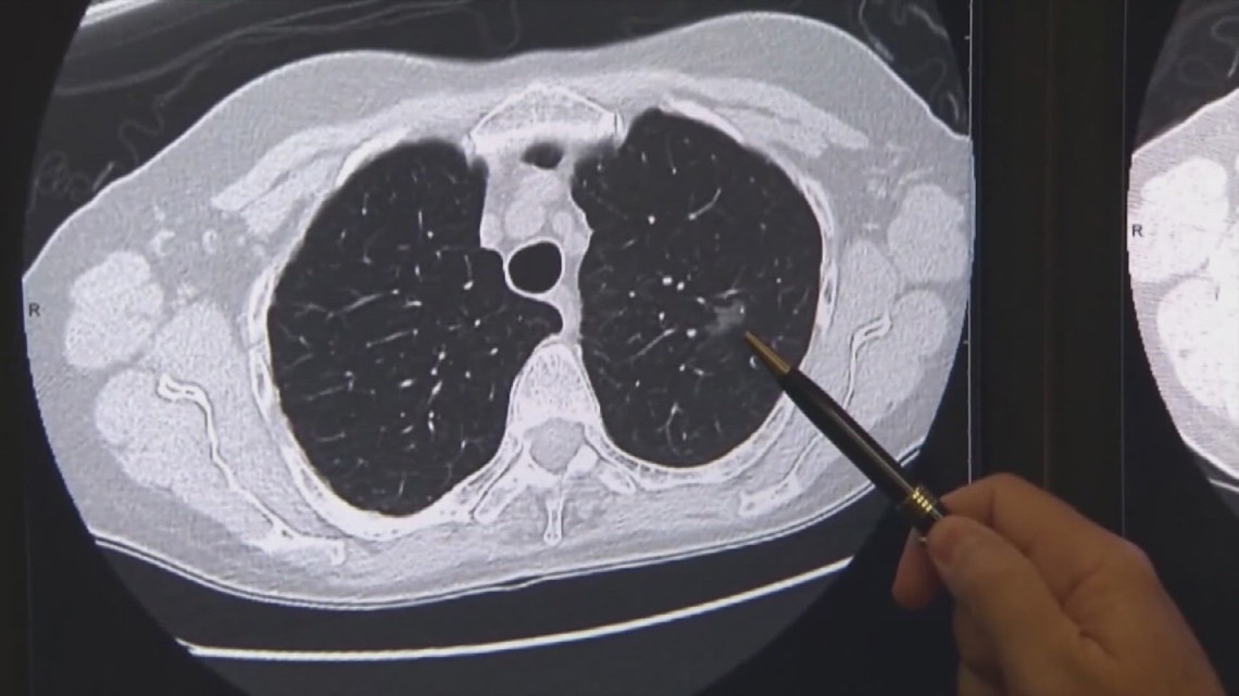 UT Medical Center first in the South to use Cytalux, a drug that ‘lights up’ lung cancer cells [Video]