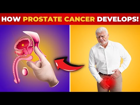 How PROSTATE CANCER Develops Must Watch | Fit & Well over 50 [Video]