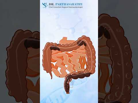 How is Colorectal Cancer Diagnosed? | Dr Parthasarathy [Video]