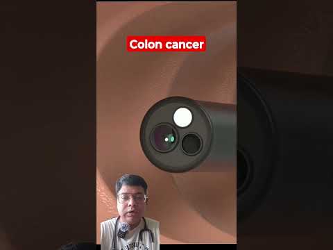 Diagnosis of Colon Cancer/Tumor [Video]