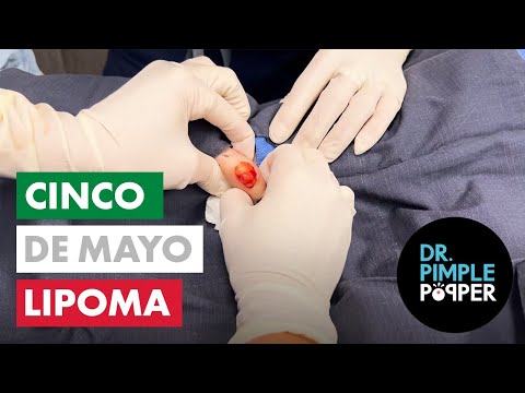 Cinco de Mayo Lipoma [Video]