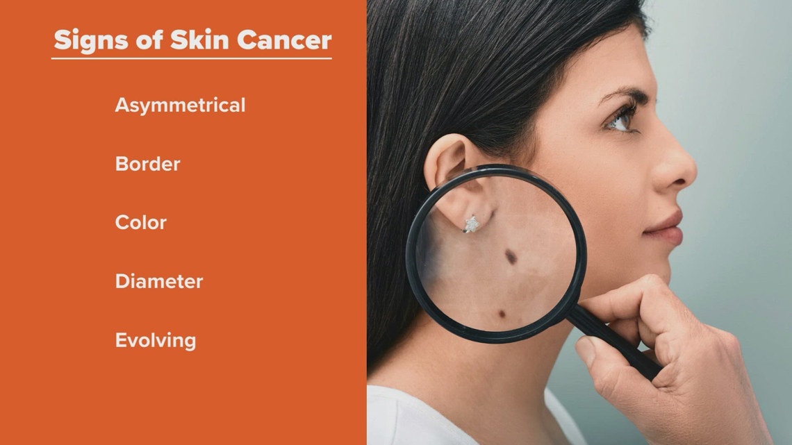 Melanoma Monday raises awareness for the risks of skin cancer [Video]