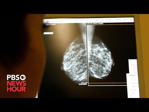 Mammograms should start at 40, government task force recommends [Video]