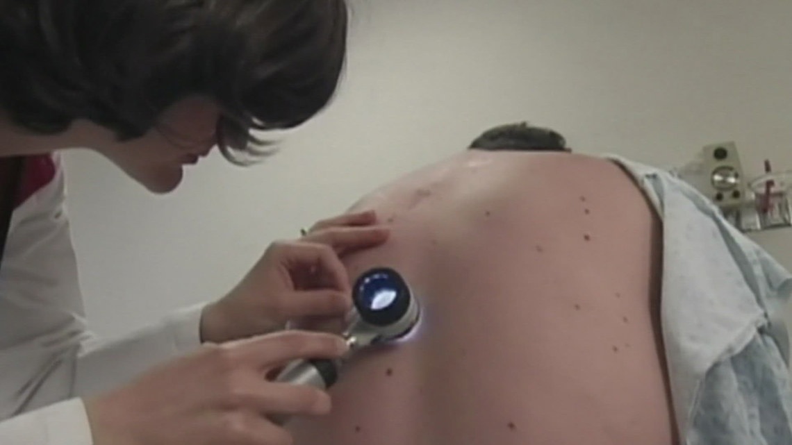 Melanoma Monday: New hope for those with advanced disease [Video]