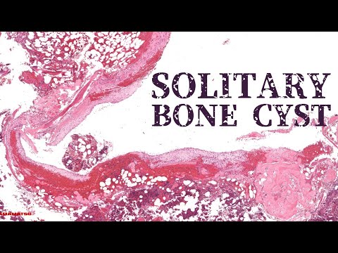 Solitary bone cyst aka Unicameral bone cyst [UBC] aka Simple bone cyst (pathology orthopedics) [Video]