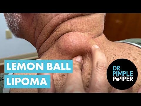 Dr Pimple Popper vs The Lemon Ball Lipoma [Video]