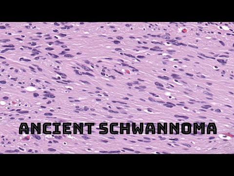 “Ancient” Schwannoma (with benign degenerative atypia/pleomorphism) pathology [Video]