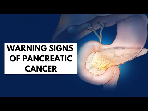 ABSURD 6 Warning Signs of Pancreatic Cancer [Video]