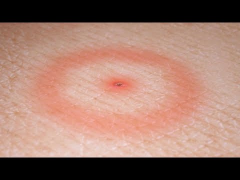 Lyme Disease: Symptoms, Treatments, and Ways to Avoid Getting a Deer Tick Bite [Video]
