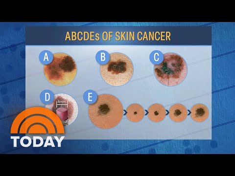 What to know about skin cancer: Self-exams, safety tips, more [Video]