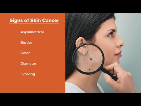Melanoma Monday raises awareness for the risks of skin cancer [Video]