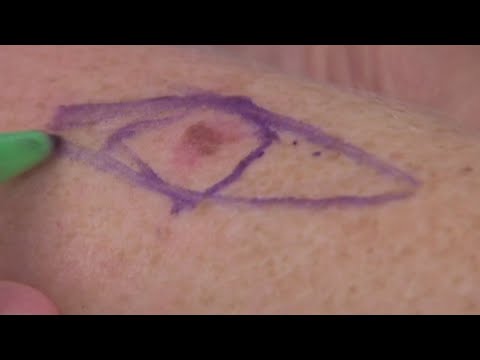 Doctors debunk skin cancer misconceptions, myths [Video]