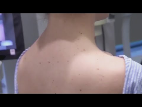 Pittsburgh dermatologist shares tips for preventing melanoma [Video]