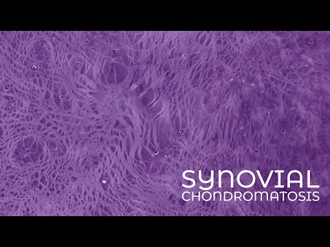 Synovial Chondromatosis (cartilage nodules in joint synovium) pathology [Video]