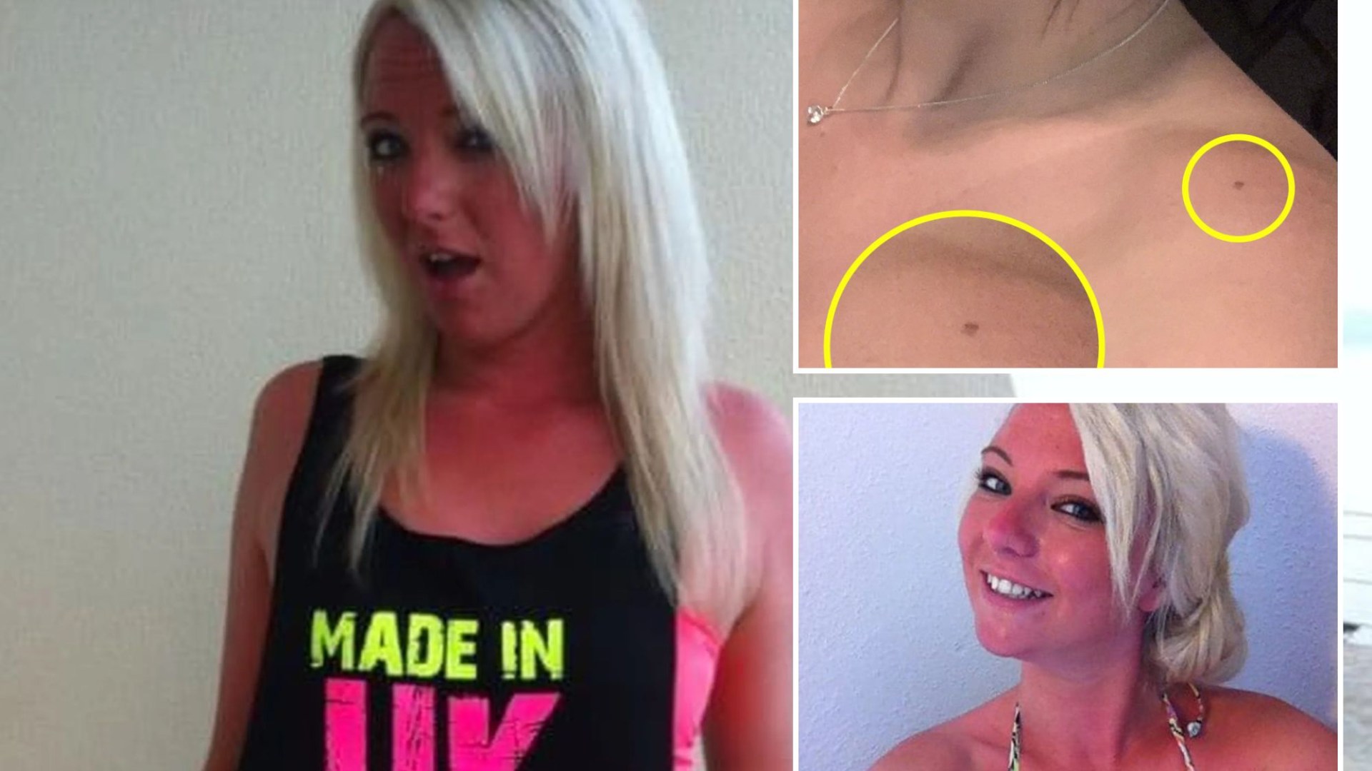 NHS worker who ‘burnt bright red to tan’ and topped up with sunbeds ‘can’t go out in daylight’ after deadly diagnosis [Video]