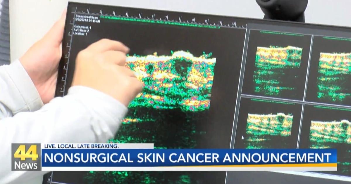 Evansville gets advanced nonsurgical treatment for common skin cancer | Video