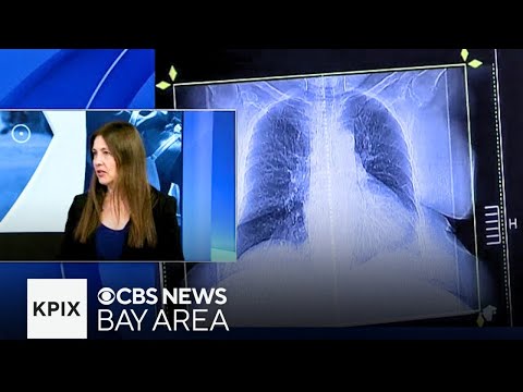 In Focus: Lung cancer in Asian American women [Video]
