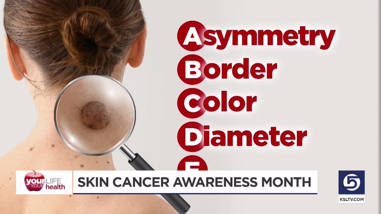 Video: Sun safety reminders for Skin Cancer Awareness Month [Video]
