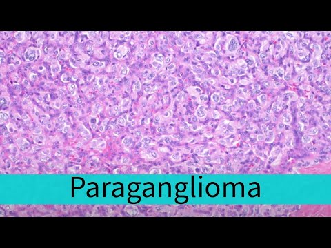 Paraganglioma under the microscope (carotid body paraganglioma) pathology [Video]